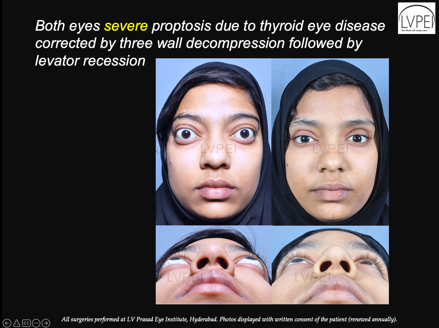 Thyroid Eye Disease 9098